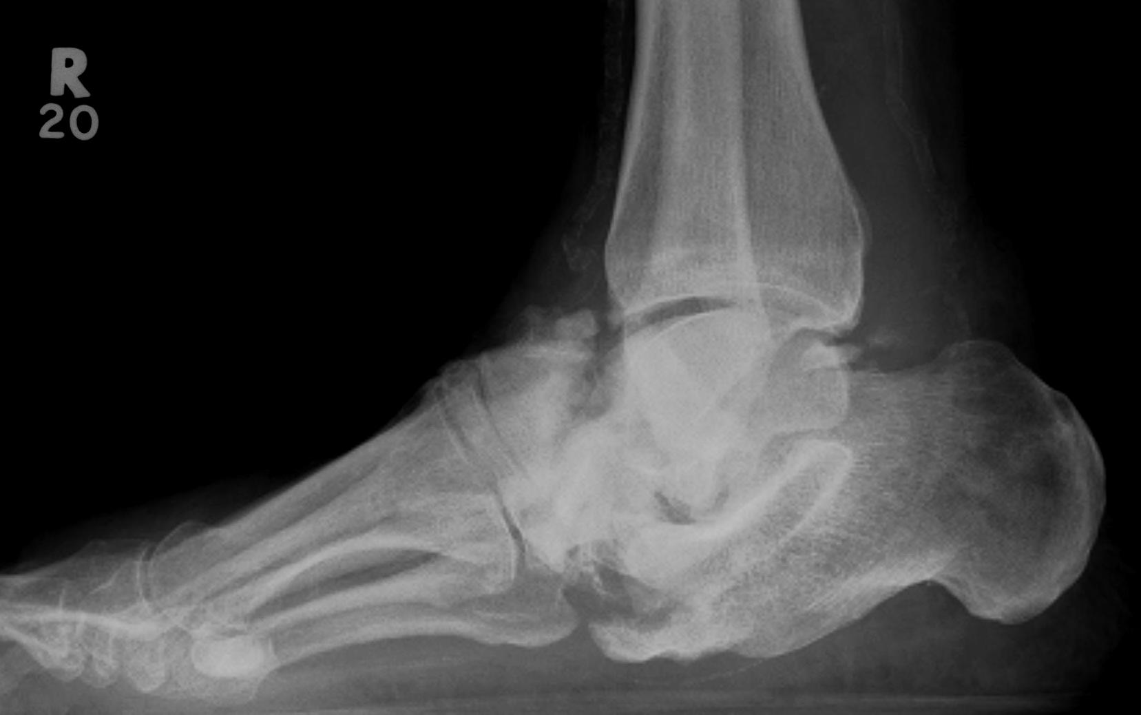 Charcot Foot Lateral